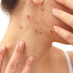 Women with adult pimples